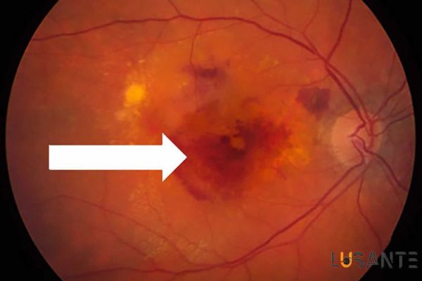 Advanced neovascularization; Prevent Age Related Macular Degeneration; lusante.com