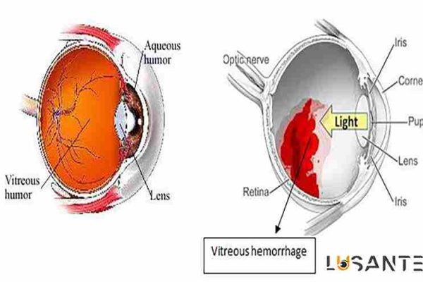 Bleeding of the vitreous eye; lusante.com