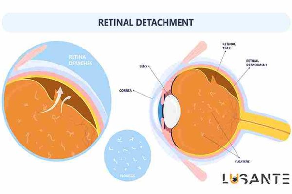 Detachment of the retina ; lusante.com