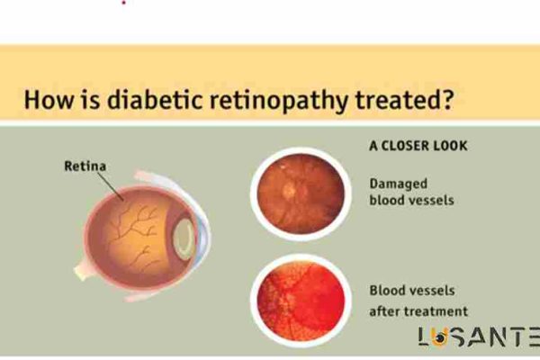 Diabetic retinopathy treatment methods ; lusante.com