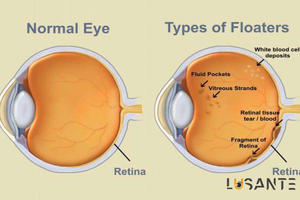 Floaters and Flashes; Retinal Vascular Disorders; lusante.com