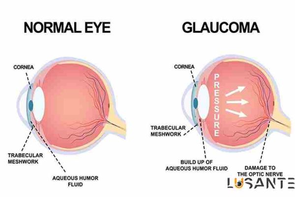 Glaucoma or glaucoma ; lusante.com