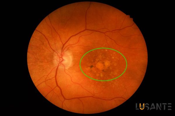 Intermediate and final AMD; Prevent Age Related Macular Degeneration; lusante.com