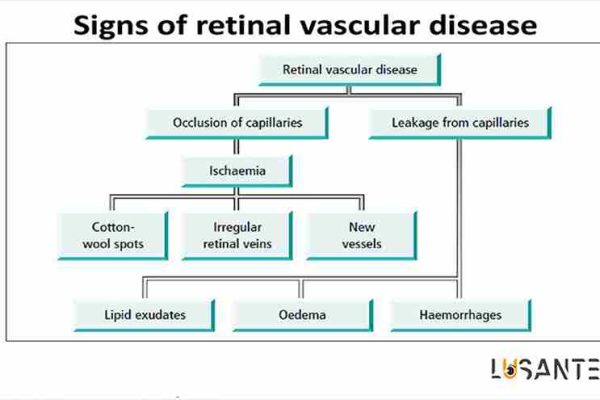 Retinal vascular diseases ; lusante.com