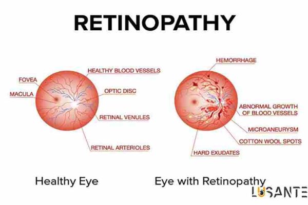 Retinopathy ; lusante.com