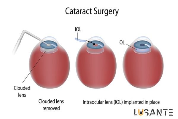 Treatment-of-cataracts; lusante