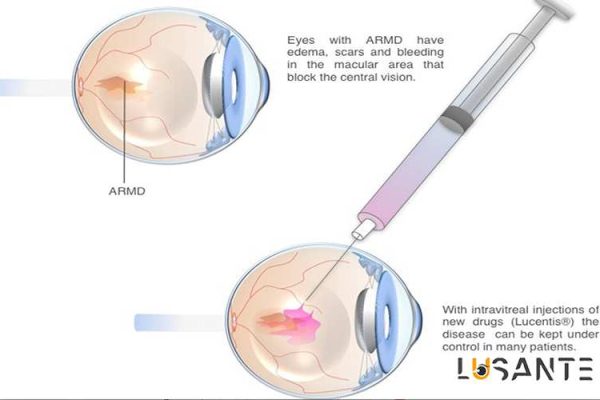 Retinal Vascular Disorders; Treatment of macular degeneration; lusante.com