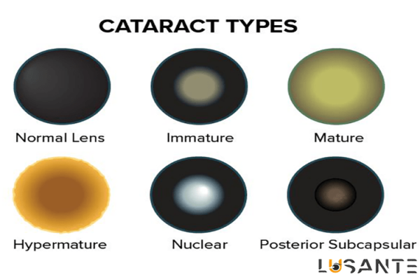 Types-of-cataracts; lusante