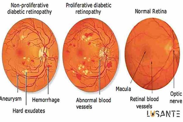 Types of retinopathy ; lusante.com