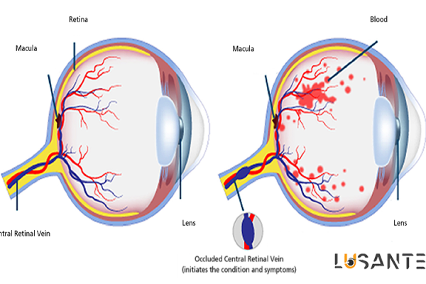 What are the different types of retinal vessel occlusion; lusante