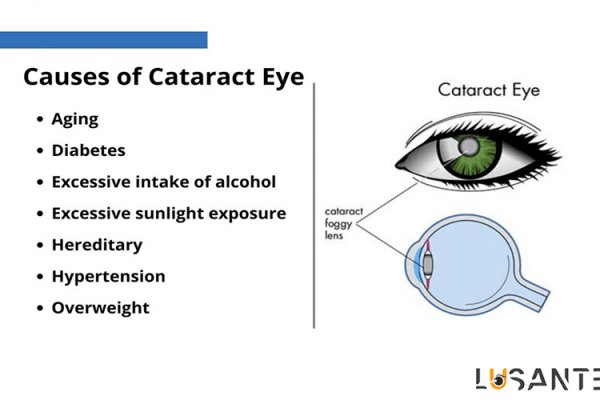 What-causes-cataracts; lusante