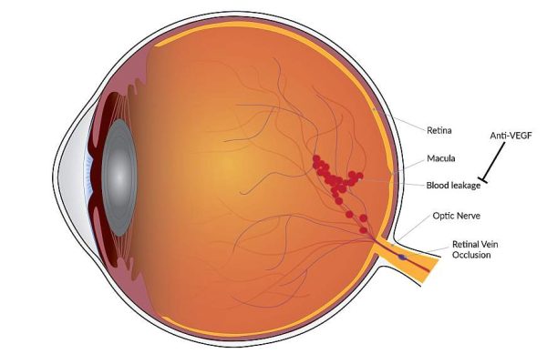 What is Retinal Vascular occlusion; lusante