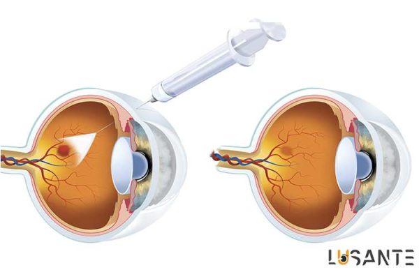 What is anti-VEGF injection; Prevent Age Related Macular Degeneration; lusante.com