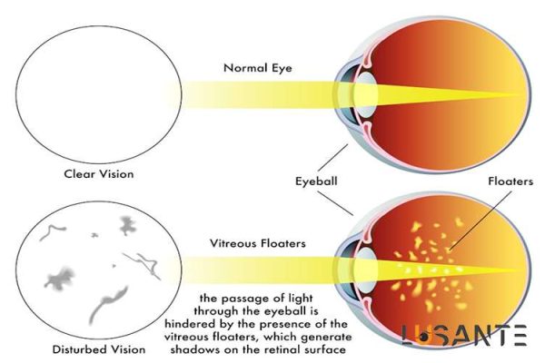 Causes of Floaters and Flashes; Retinal Vascular Disorders; lusante.com