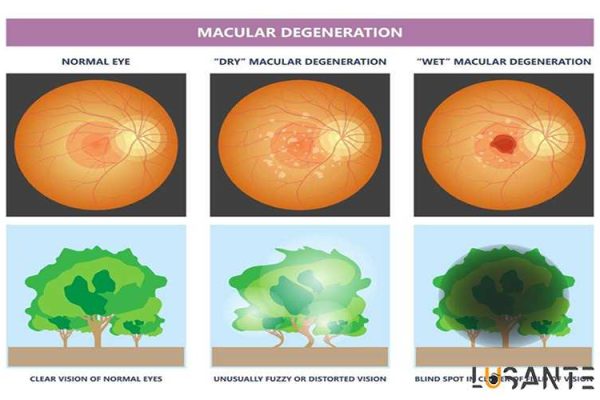 stages of macular degeneration; Prevent Age Related Macular Degeneration; lusante.com