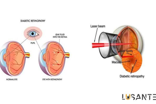 Diabetes And Vision loss; Laser treatment ; lusante.com