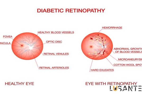 Diabetes And Vision loss; Diabetic Maculopathy; lusante.com