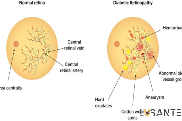 Diabetes And Vision loss; Diabetic retinopathy; lusante.com