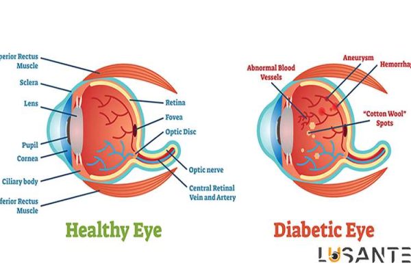 Diabetes And Vision loss; Other effects of diabetes on the eyes; lusante.com