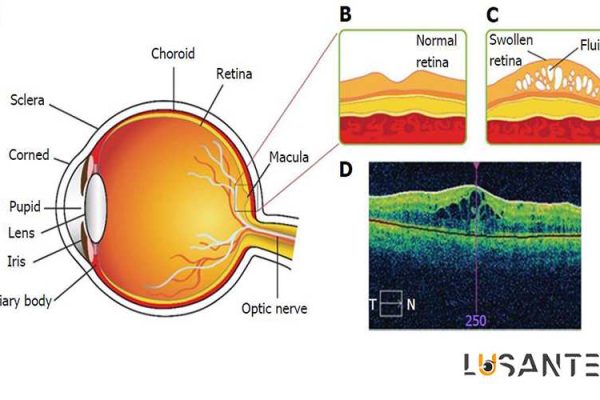 Diabetes And Vision loss; Treatment of diabetic macula; lusante.com