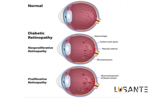 Diabetes And Vision loss; Stages of diabetic retinopathy; lusante.com