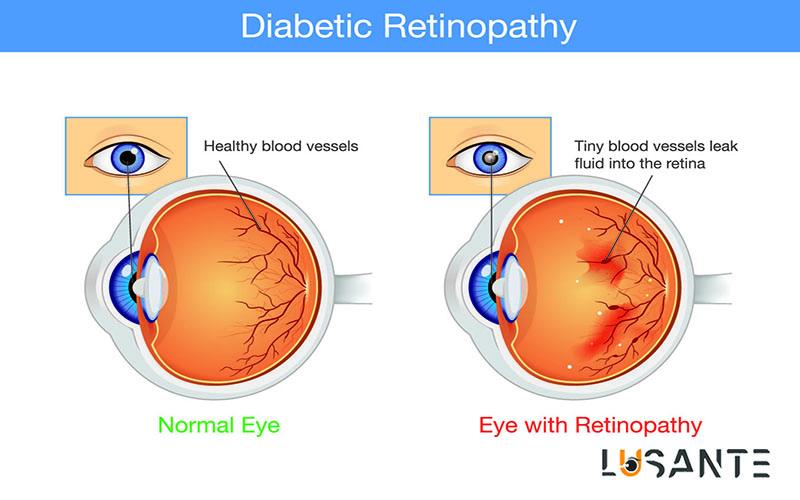 Diabetes And Vision loss ; lusante.com