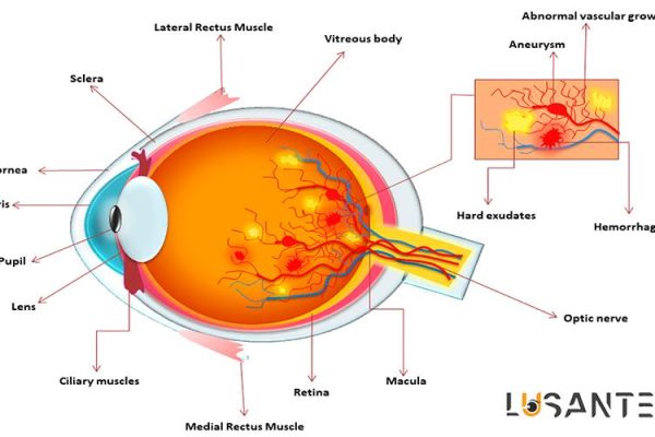 Diabetes And Vision loss; Eye complications of diabetes and its impact on vision; lusante.com