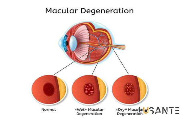 Retinal Vascular Disorders; Macular Degeneration; lusante.com