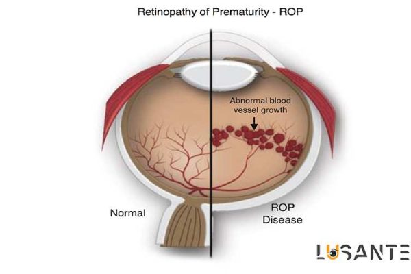 Retinal Vascular Disorders; Retinopathy of Prematurity; lusante.com