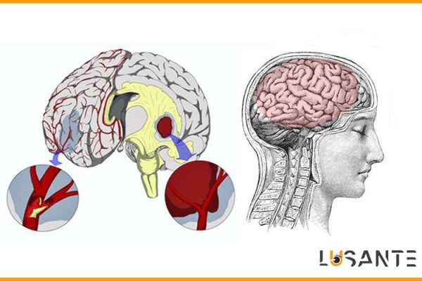 How to prevent hypertension; Brain Damage; lusante.com