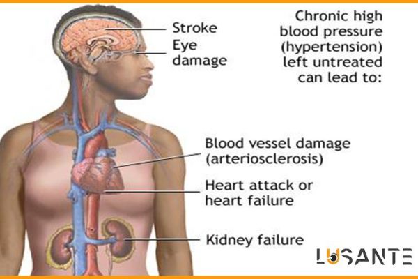 How to prevent hypertension; What are the effects of Hypertension on the body; lusante.com