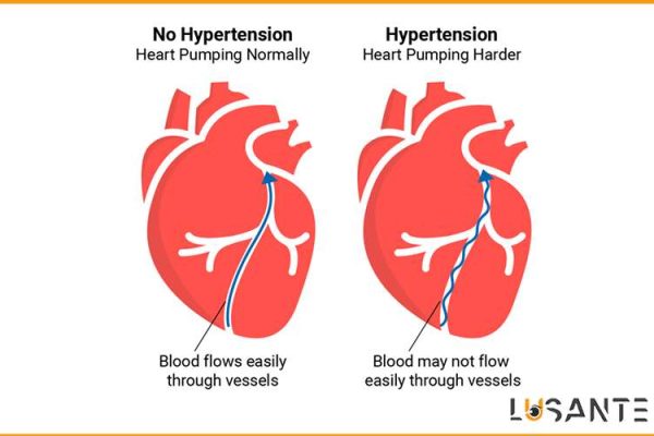 prevent hypertension; What is Hypertension; lusante.com