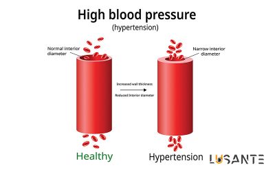 Prevent Hypertension; lusante.com