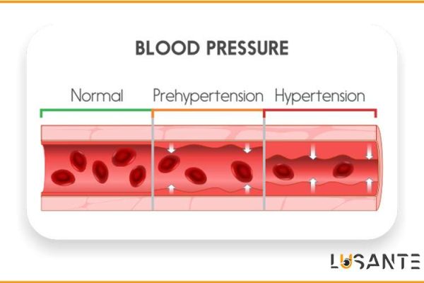 prevent hypertension; What is blood pressure; lusante.com