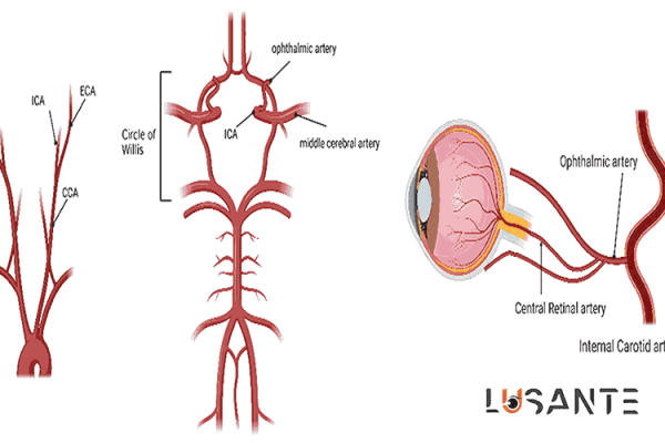 Ocular Ischemic Syndrome; lusante.com