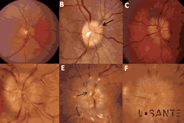 Specialized Evaluation for Transient Vision Loss; Papilledema; lusante.com