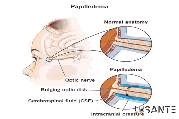 Transient Vision Loss; Treatment of Papilledema; lusante.com