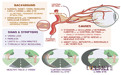 Transient Vision Loss; lusante.com