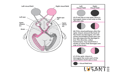 sudden vision loss; lusante.com