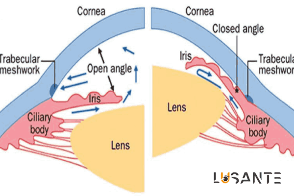 sudden vision loss; Angle-Closure Glaucoma and Vision Loss; lusante.com