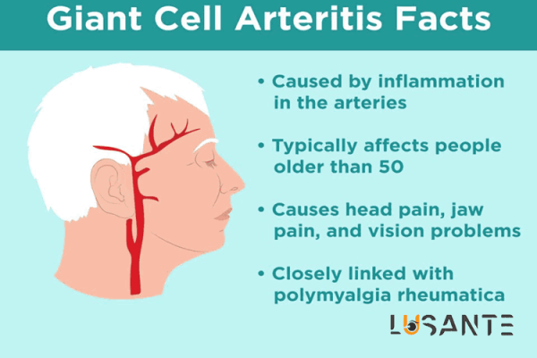 sudden vision loss; Giant Cell Arteritis; lusante.com