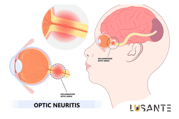 sudden vision loss; Optic Nerve Disorders; lusante.com