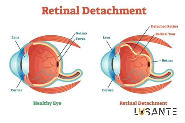 sudden vision loss; Retinal Disorders; lusante.com