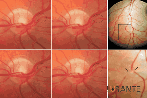 sudden vision loss Retinal Vasospasm; lusante.com