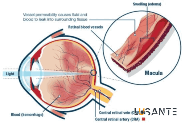 sudden vision loss; Vascular Events; lusante.com